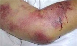 تب کریمه کنگو